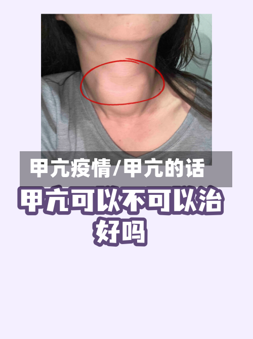 甲亢疫情/甲亢的话