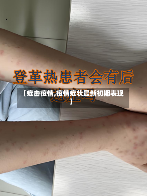 【症击疫情,疫情症状最新初期表现】-第2张图片